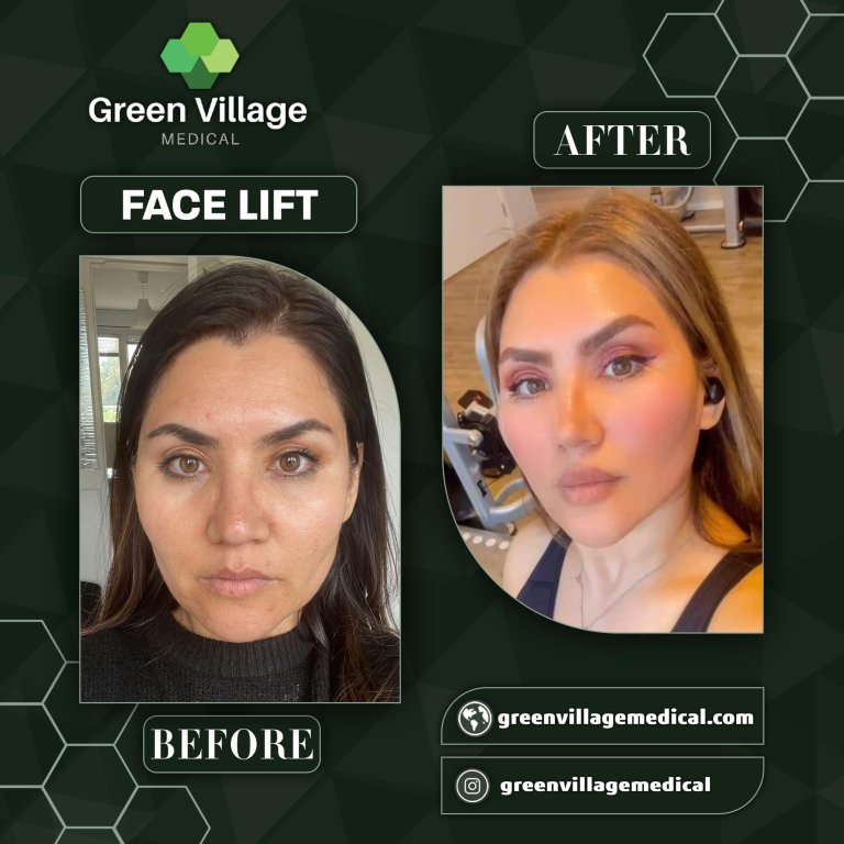 face lift 11